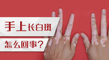 手部白癜风容易扩散吗 成都西部白癜风医院